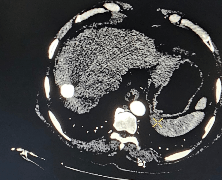 Chemoembolization of liver cancer - after