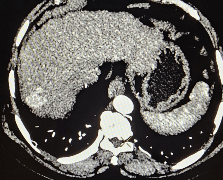 Chemoembolization of liver cancer - after