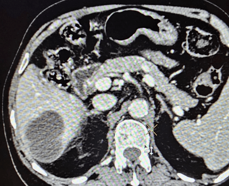 Chemoembolization of liver cancer - after
