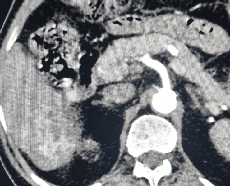 Chemoembolization of liver cancer - after