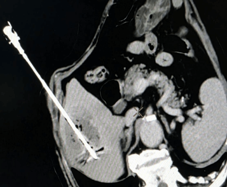 Chemoembolization of liver cancer - after