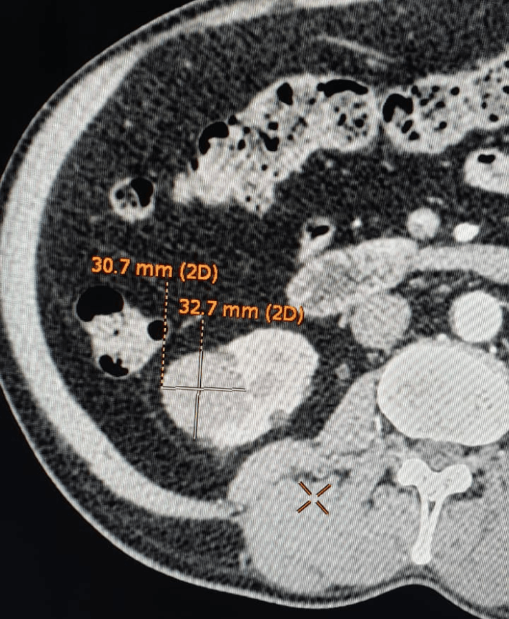 Kidney cancer treatment by microablation - post