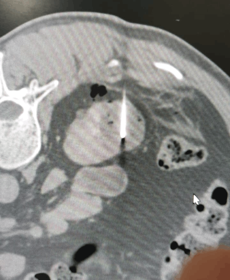 Kidney cancer treatment by microablation - post