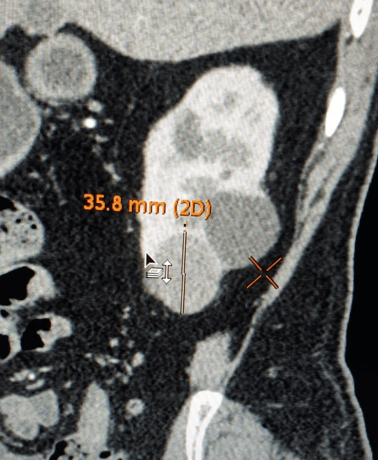Kidney cancer treatment by microablation - pre