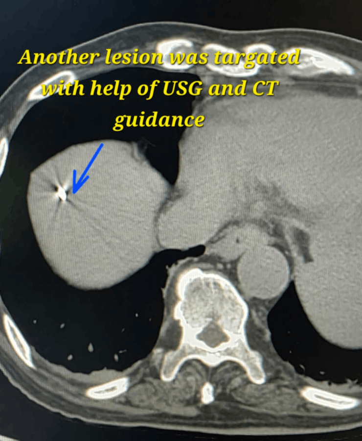 Chemoembolization of liver cancer - before
