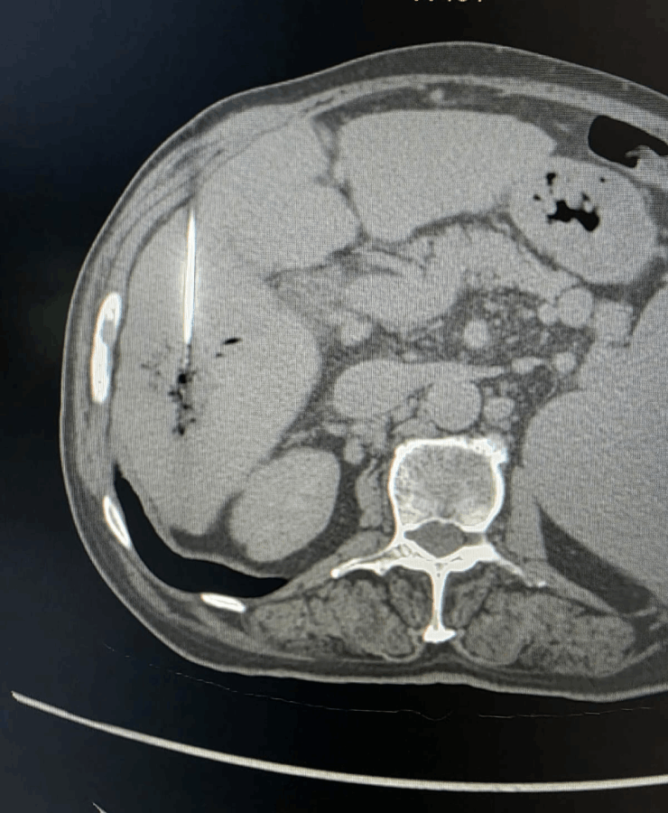 Chemoembolization of liver cancer - after