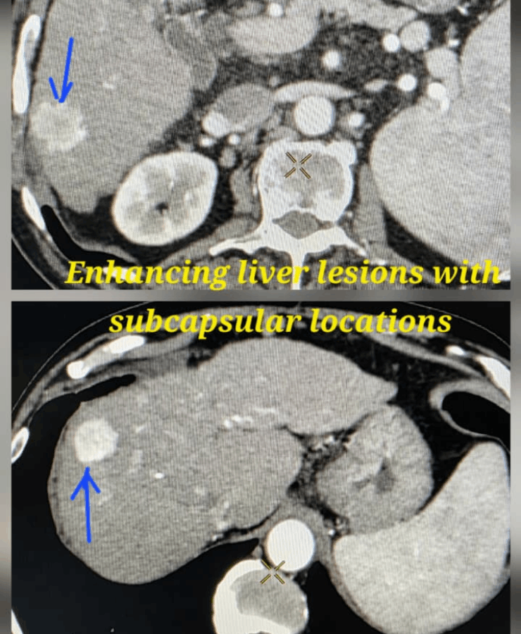 Chemoembolization of liver cancer - after