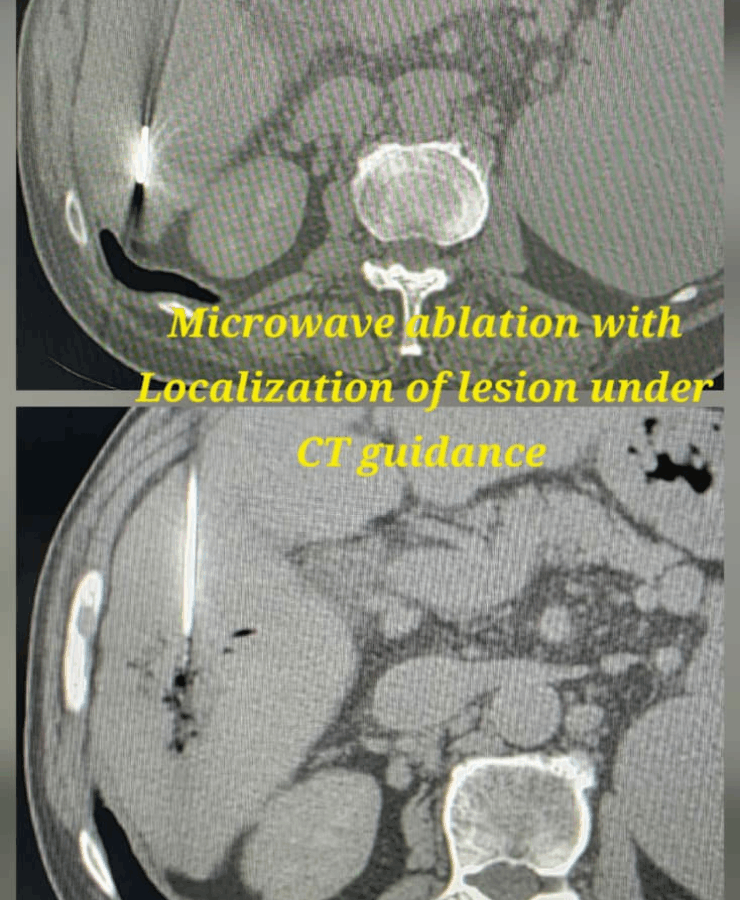 Chemoembolization of liver cancer - after