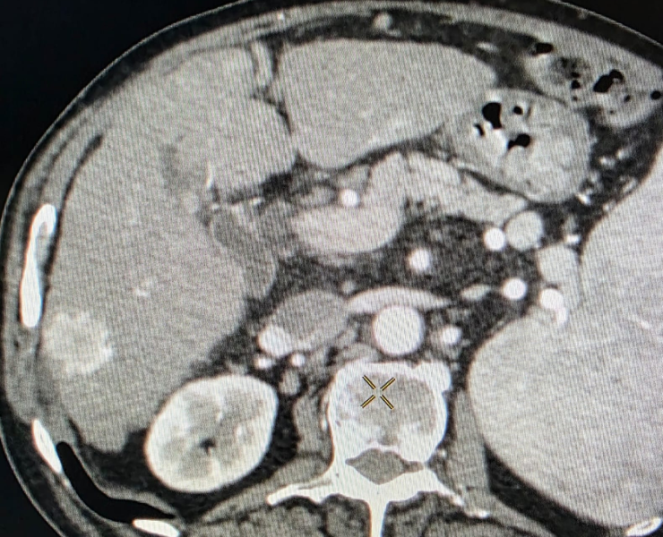 Chemoembolization of liver cancer - after