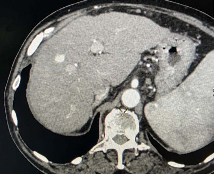 Chemoembolization of liver cancer - before