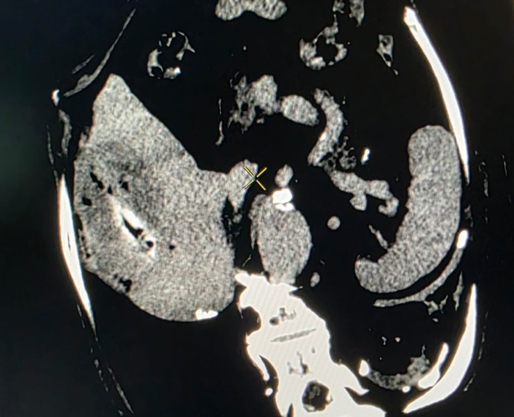 Chemoembolization of liver cancer - before