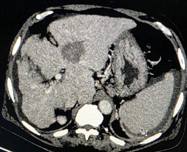 Chemoembolization of liver cancer - after