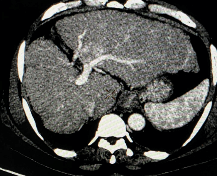 Interventional cancer treatment