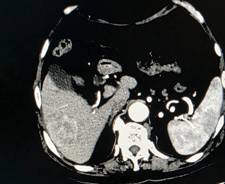 Chemoembolization of liver cancer - before