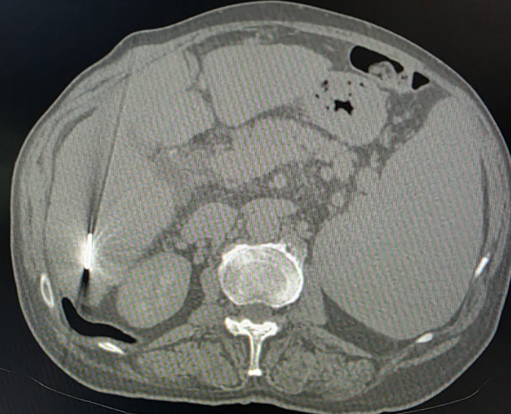 Chemoembolization of liver cancer - after