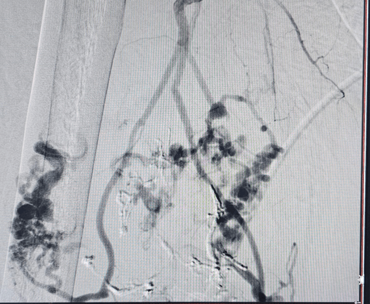 Complex vascular malformation angiography view 2