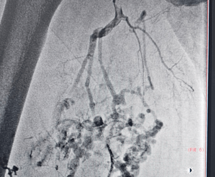Treatment of Complex Vascular Malformations