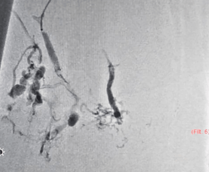 Post treatment angiography