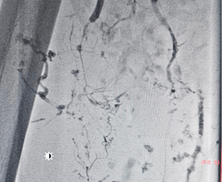 Post treatment angiography view 1