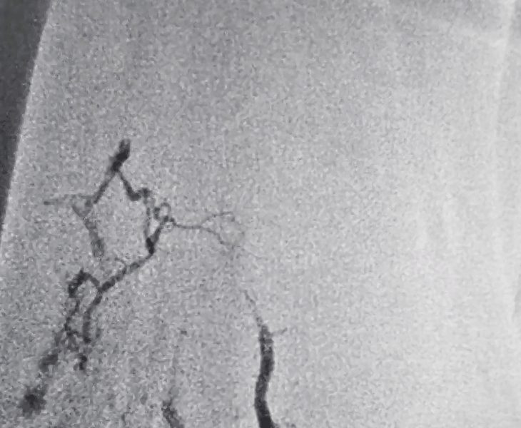 Post treatment angiography view 2