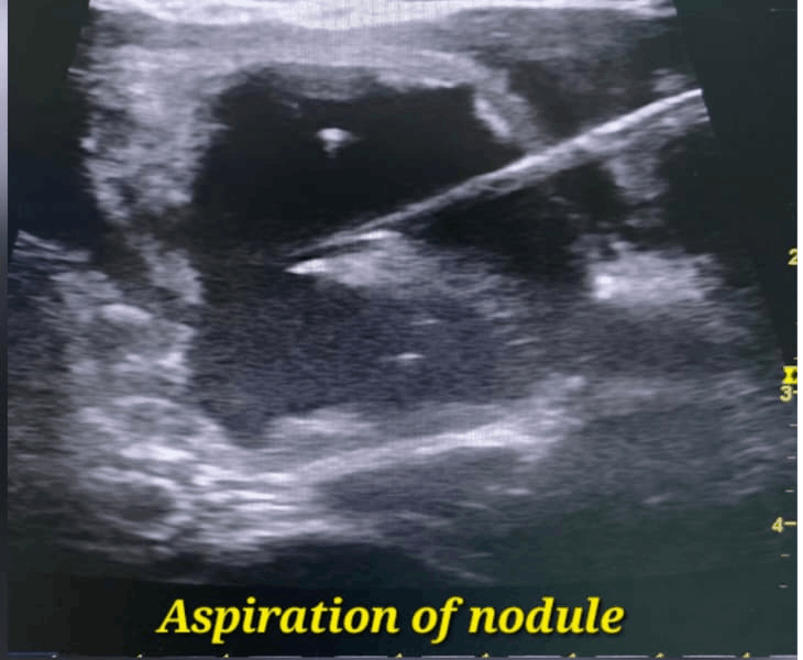 Microwave ablation under ultrasound guidance