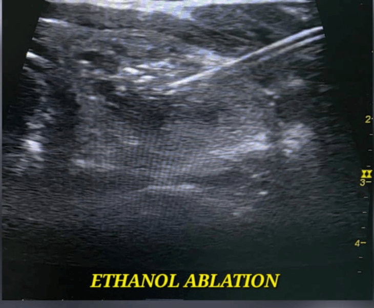 Ethanol ablation under ultrasound