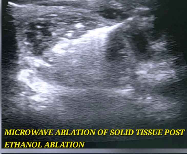 Microwave ablation of solid tissue post ethanol ablation