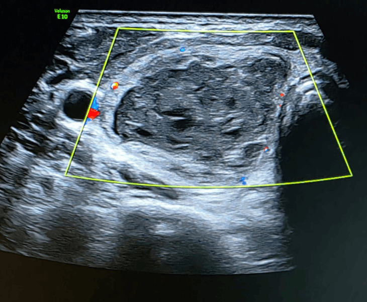 Ethanol and Microwave Ablation for Thyroid Nodules