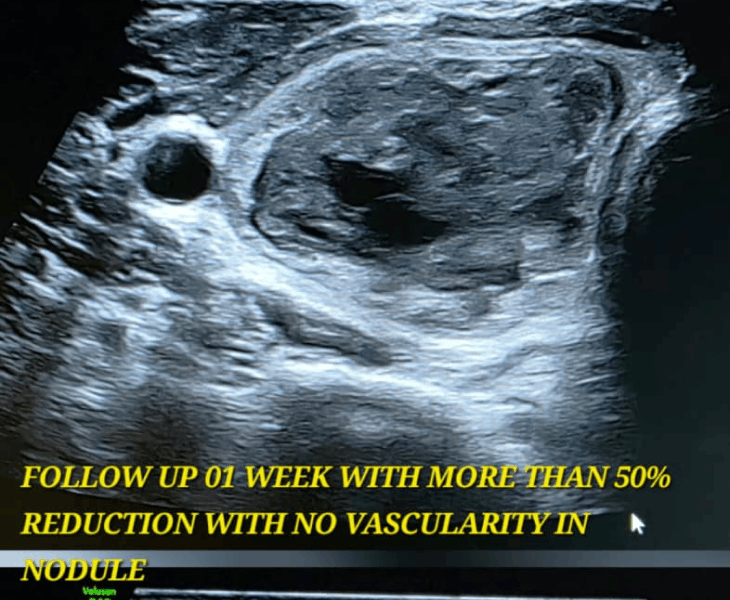 Follow up reduction with no vascularity in thyroid nodule