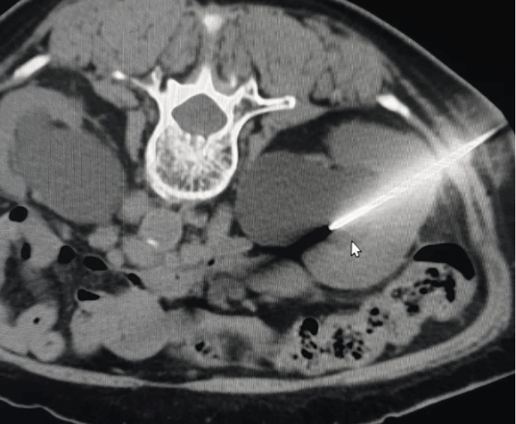 CT-guided drainage of obstructed kidney systems
