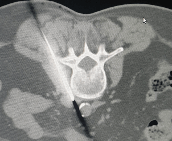 Biopsy of small abdominal lesions