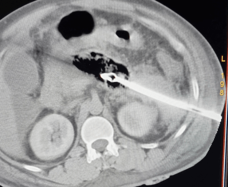 Drainage of pancreatic collection