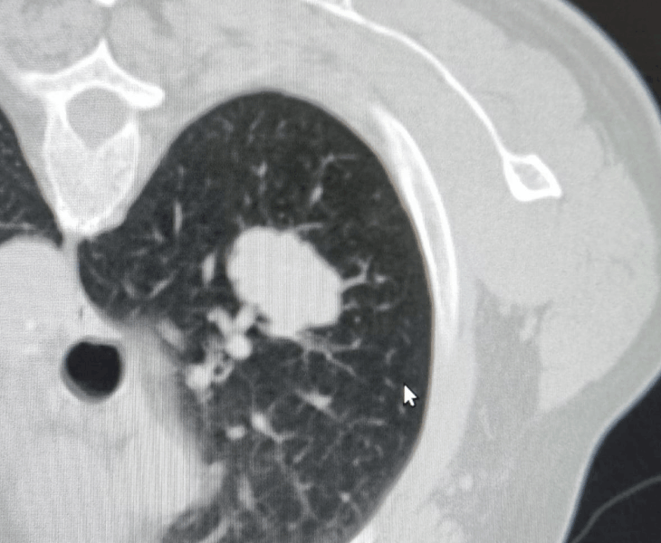 Lung and mediastinal cancer biopsies