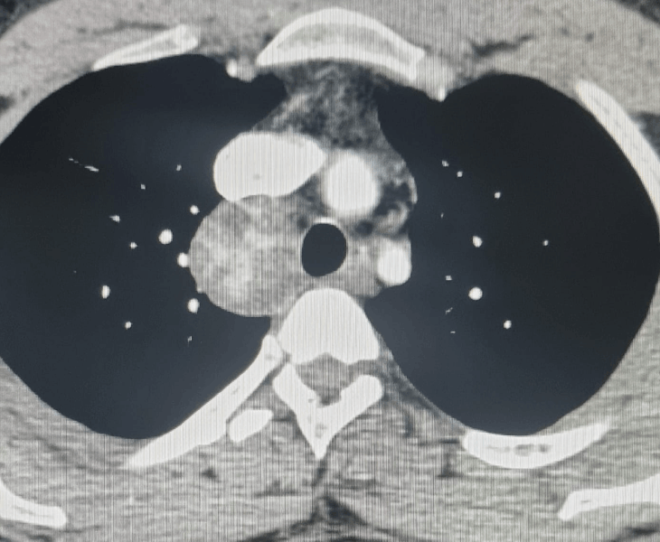 CT image of mediastinal region