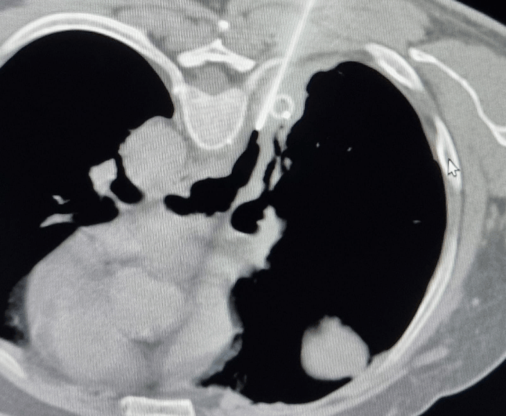 Lung and mediastinal drainage procedures