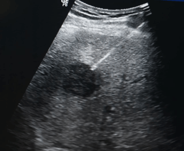 USG-guided metallic marker placement