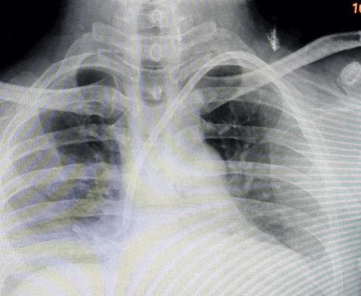 Post procedure chest X-ray for catheter position