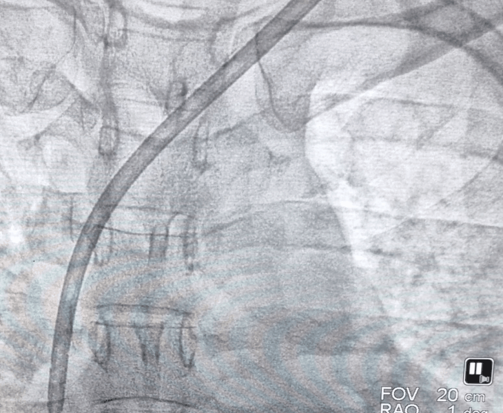 Fluoroscopy guidance during permcath placement