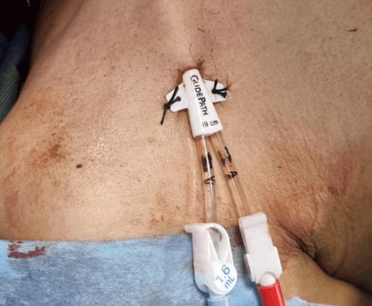 Permcath Dialysis Catheter Insertion