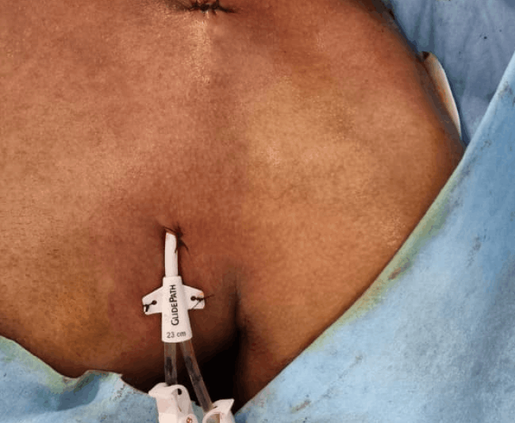 Permcath in place on chest