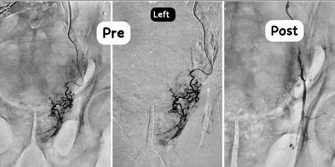 Prostatic Artery Embolization