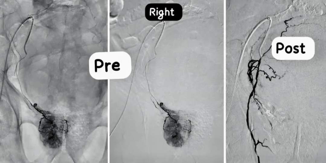 Prostatic artery embolization selective angiogram