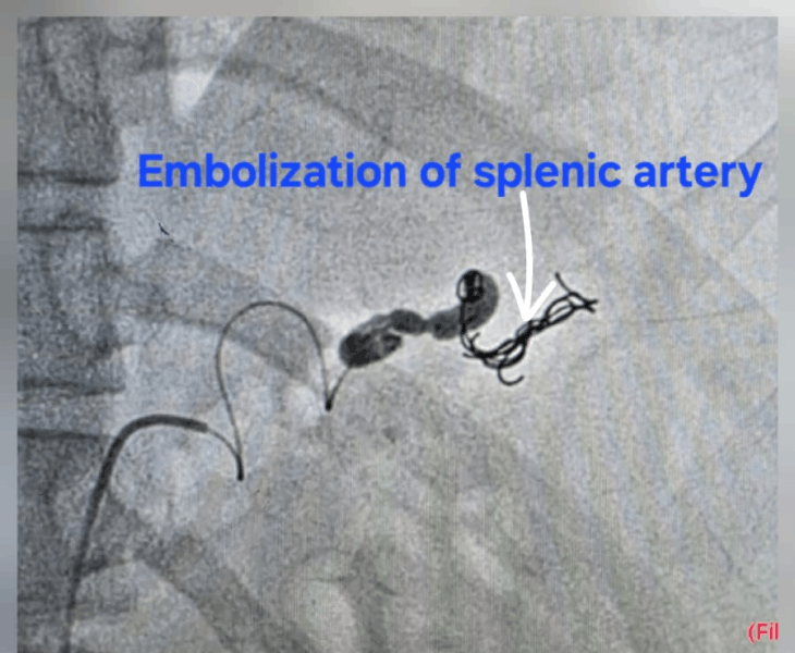 Post embolization angiography