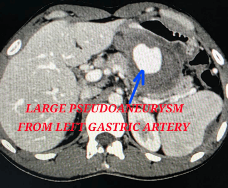 Coil mass with obliteration of aneurysm