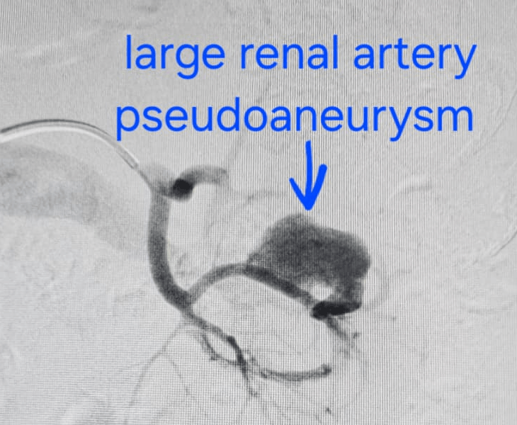 Embolization Treatment for Bleeding Pseudoaneurysms