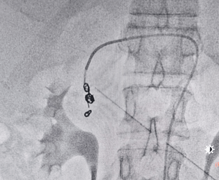 Post embolization angiography