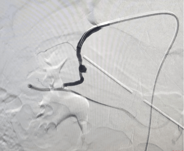 Post embolization angiography
