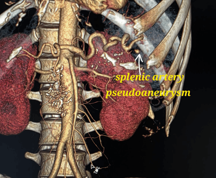 Post embolization angiography