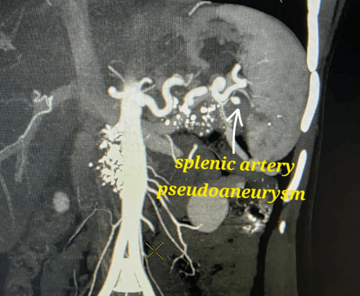 Super selective coil embolization