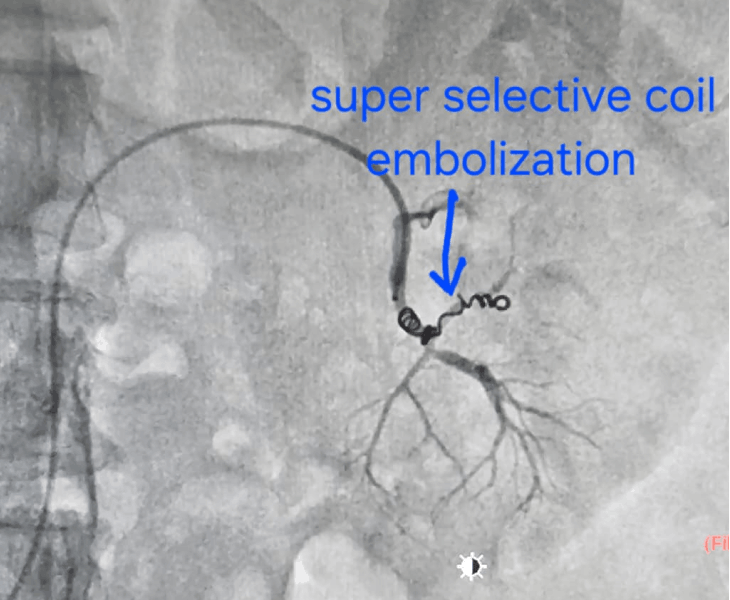 Post embolization angiography